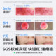 Turtle Papa Acne Essence Second-Purpose First-Aid Acne and Oil Control