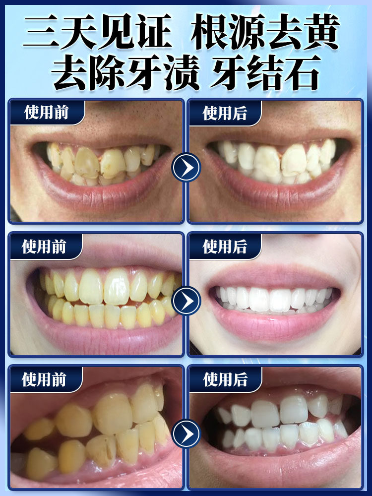 牙齿神器变白去黄牙洁洗白洗牙粉 乖儿适牙粉