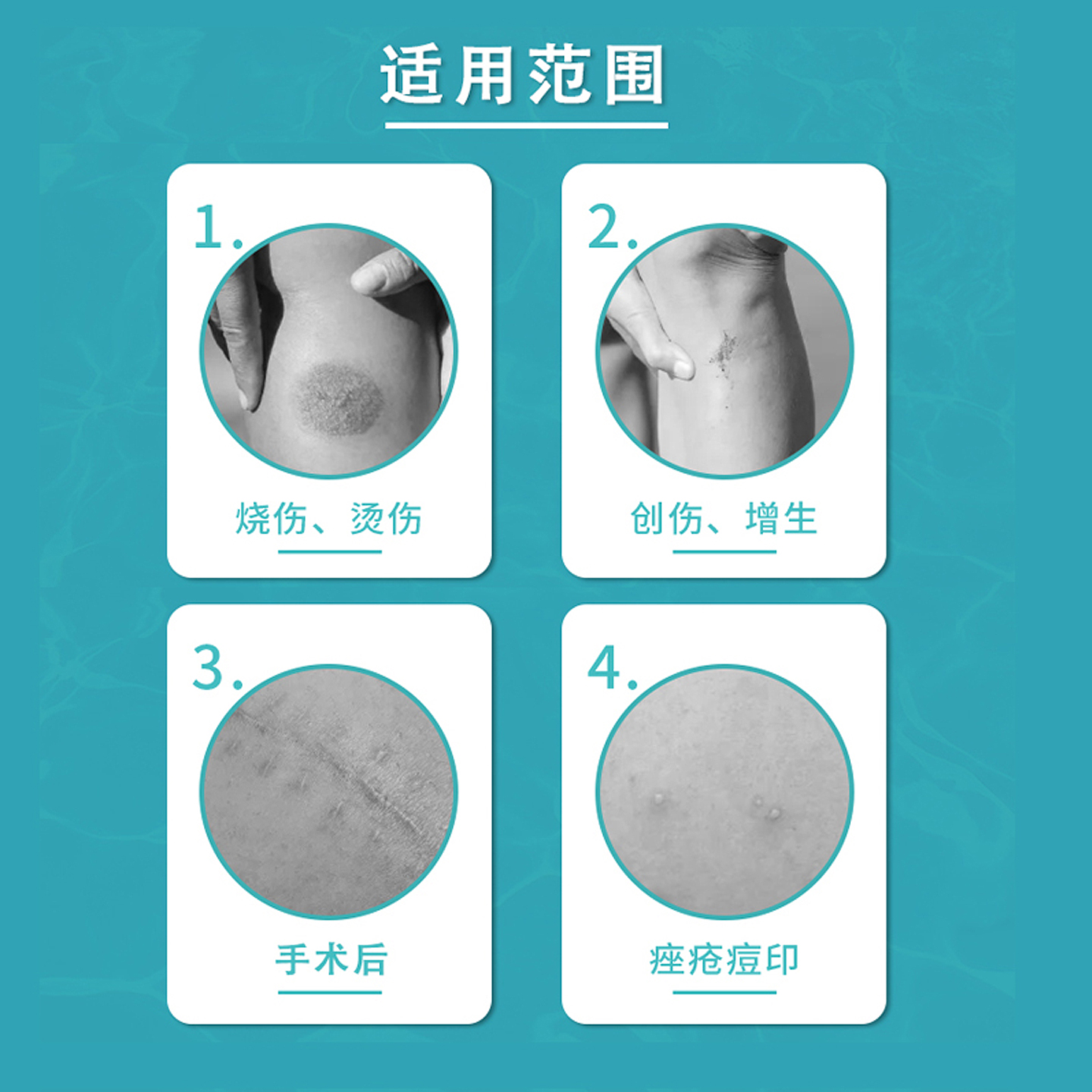 北京同仁堂祛疤膏儿童小孩去疤痕剖腹产痘印烫伤医用硅酮祛疤凝胶