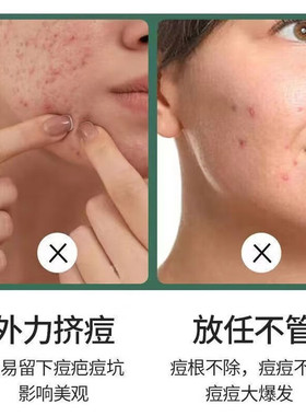 修正丹参祛痘凝胶草本净痘闭口粉刺痘印熬夜痘上火痘青春痘油痘肌