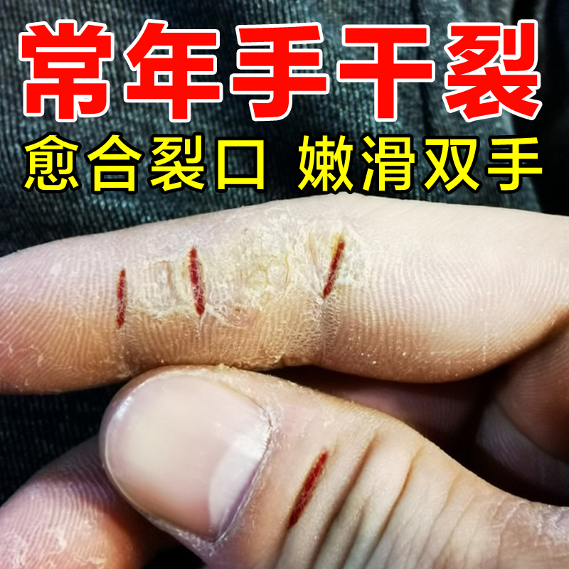 南京同仁堂脚后跟干裂去死皮神器防裂膏手足手指开裂修复霜旗舰店