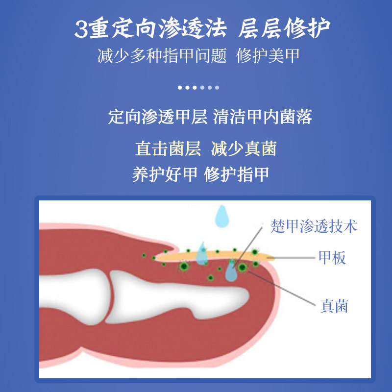 软函甲康灵抑菌正品灰指甲液 软函医疗器械保健理疗