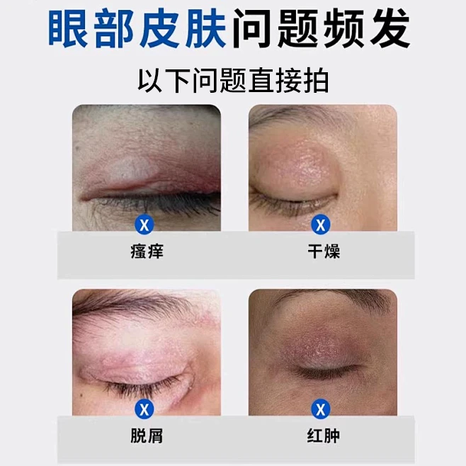 眼皮神经性皮炎眼皮癣眼睛周围眼角痒干燥起皮掉屑红肿过敏发痒JW - 图0