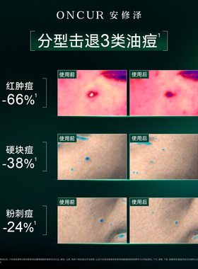 【双11立即付定】安修泽油橄榄精华液3.0祛痘修红舒缓修护PDRN