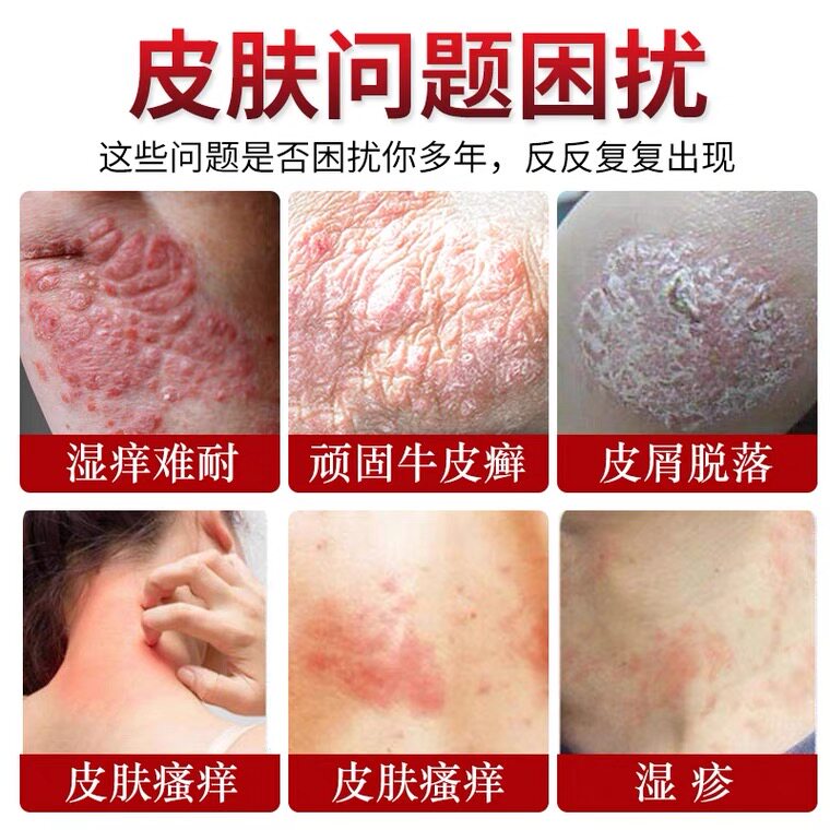 银屑病专用特效肛周顽固湿疹药膏 药郎神医用乳膏（器械）
