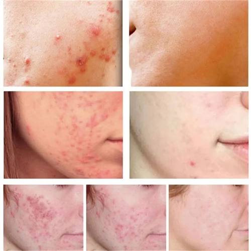 Salicylic Acid Acne atment Face Cream Repair Pimple Spots De - 图1