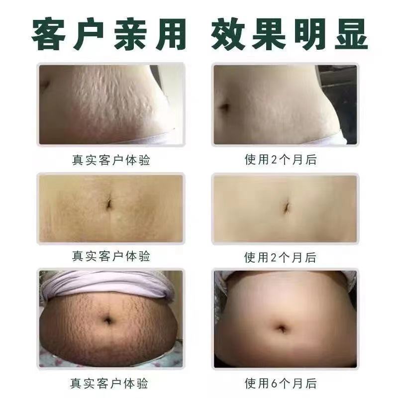 去肥胖纹生长纹大腿消除大腿去除男女学生修复霜膏淡化肥胖纹精油 去肥胖纹生长纹大腿消除大腿去除男女学生修复霜膏淡化肥胖纹精油