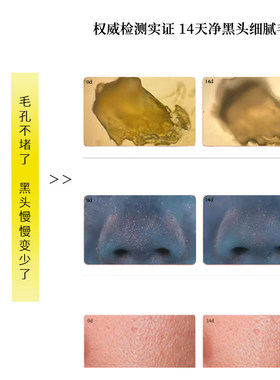 【毛孔粗大】【黑头粉刺闭口】【 控油净颜】Froms毛孔黑头净肤霜