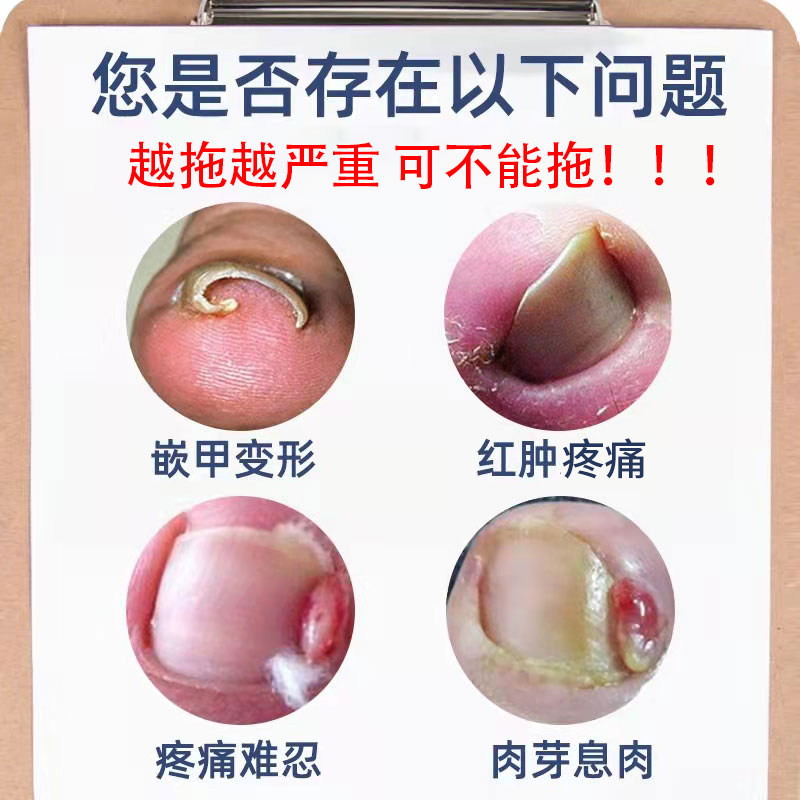 指甲长肉里红肿疼痛肉芽嵌甲膏药贴 畅瑞康保健理疗