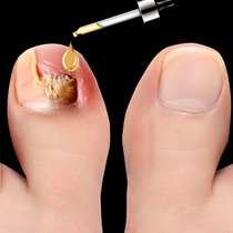 (Küchens hot selling) Drop a drop of bacteriostatic no-nail to remove 99% ash potassium fungus invalid packet withdrawal  