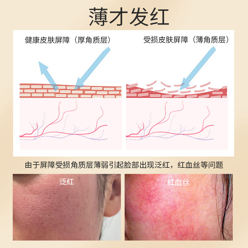 冻干粉修护红血丝角质层敏感肌去鼻翼鼻头去除脸部护肤品套装正品