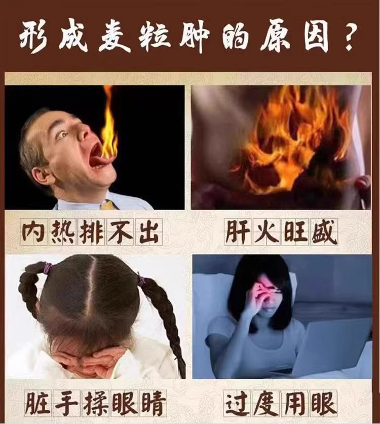 麦粒肿眼贴眼上长疙瘩眼皮红肿痒热敷疏通针眼脸板腺囊肿炎霰粒肿 - 图1