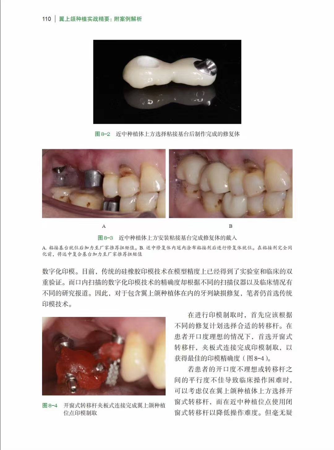 全新正版 翼上颌种植实战精要 附案例解析 舒凌 任杰 主编 上海科学技术出版社 适合口腔种植科医师阅读 上颌磨牙区垂直骨高度不足