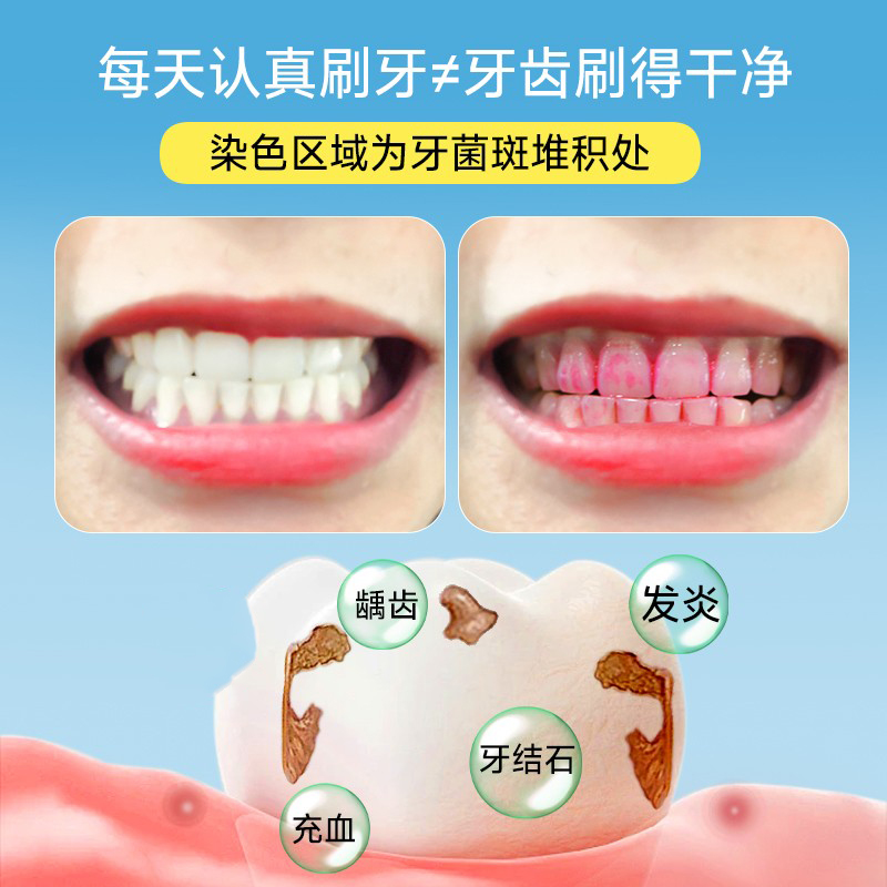 医用儿童牙菌斑显示剂成人牙齿菌斑指示剂牙垢显色神器染色显示液 - 图0