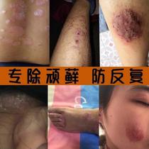 Barley PhD Net Stock Cream Stock Cream Adult Thighs Inner Skin Itching Root Stop Itching Thighs Buy 2 Send 1