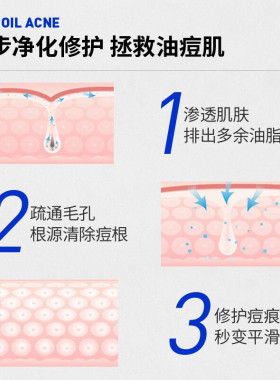 卢曼博士祛痘闭口粉刺水精华套装