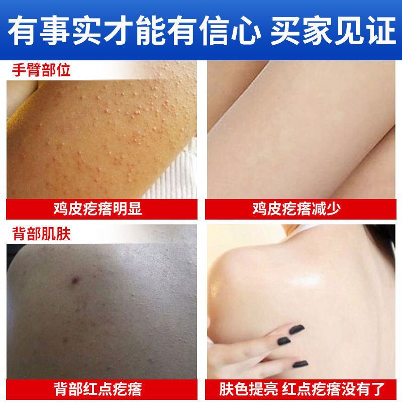 乔芙丽维E尿素霜10%去鸡皮保湿倾龄身体乳防脚后跟干裂正品旗舰店 - 图2