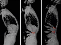 Analyse dimages de surgimap Lecture de la sine de lecture et de la planification des diagnostics dimagerie dégénérative