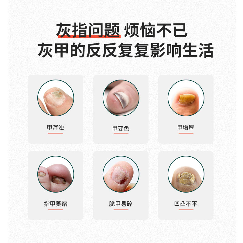 普迈迪甲沟炎手指脚趾灰指甲专用液 美适达医疗器械保健理疗