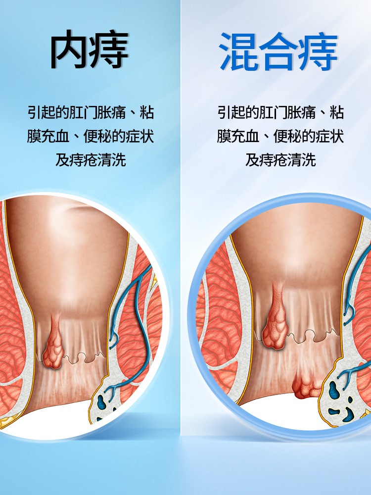 医用卡波姆痔疮洗液消肉球混合痔疮内痔瘙痔消肿疮清洗液坐浴正品 - 图1