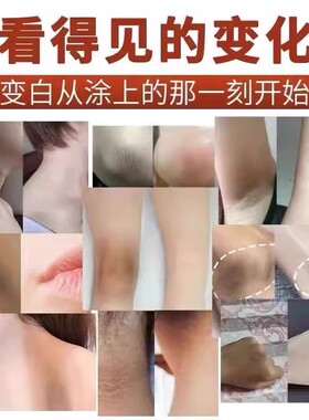 腋下手指关节膝盖手肘胳膊肘胳肢窝脖子屁股黑黑洗不掉黑色素沉淀