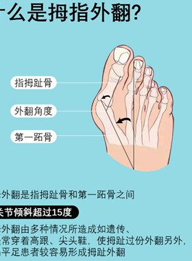 大拇指外翻矫正器硅胶脚趾分离器可穿鞋防脚气纠正脚趾拇指矫形器