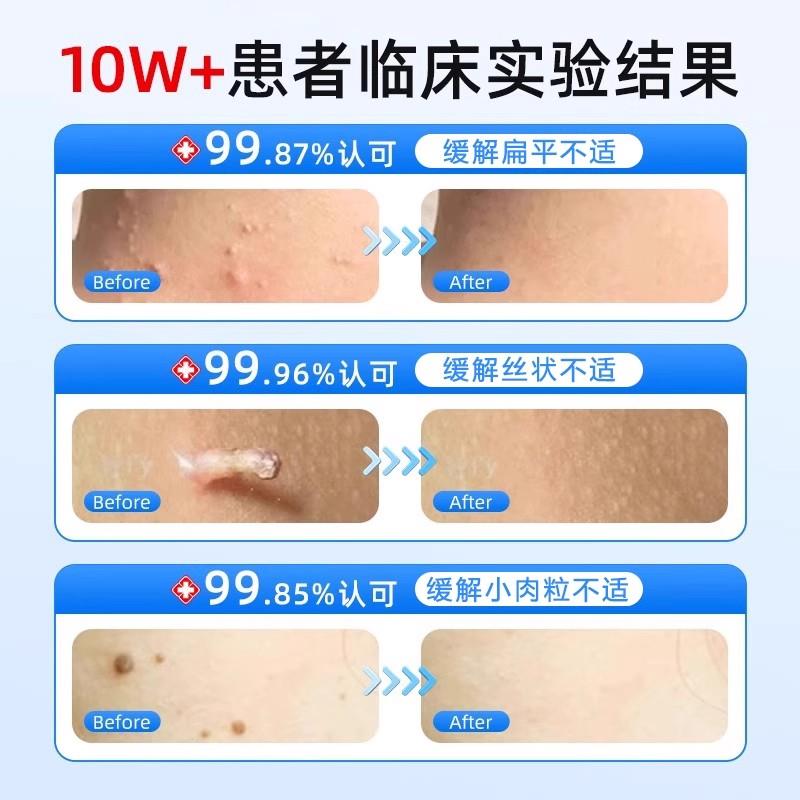 5%咪奎喹莫特乳膏正品丝状扁平尤跖尤专用百草克尤膏大药房旗舰店 - 图1