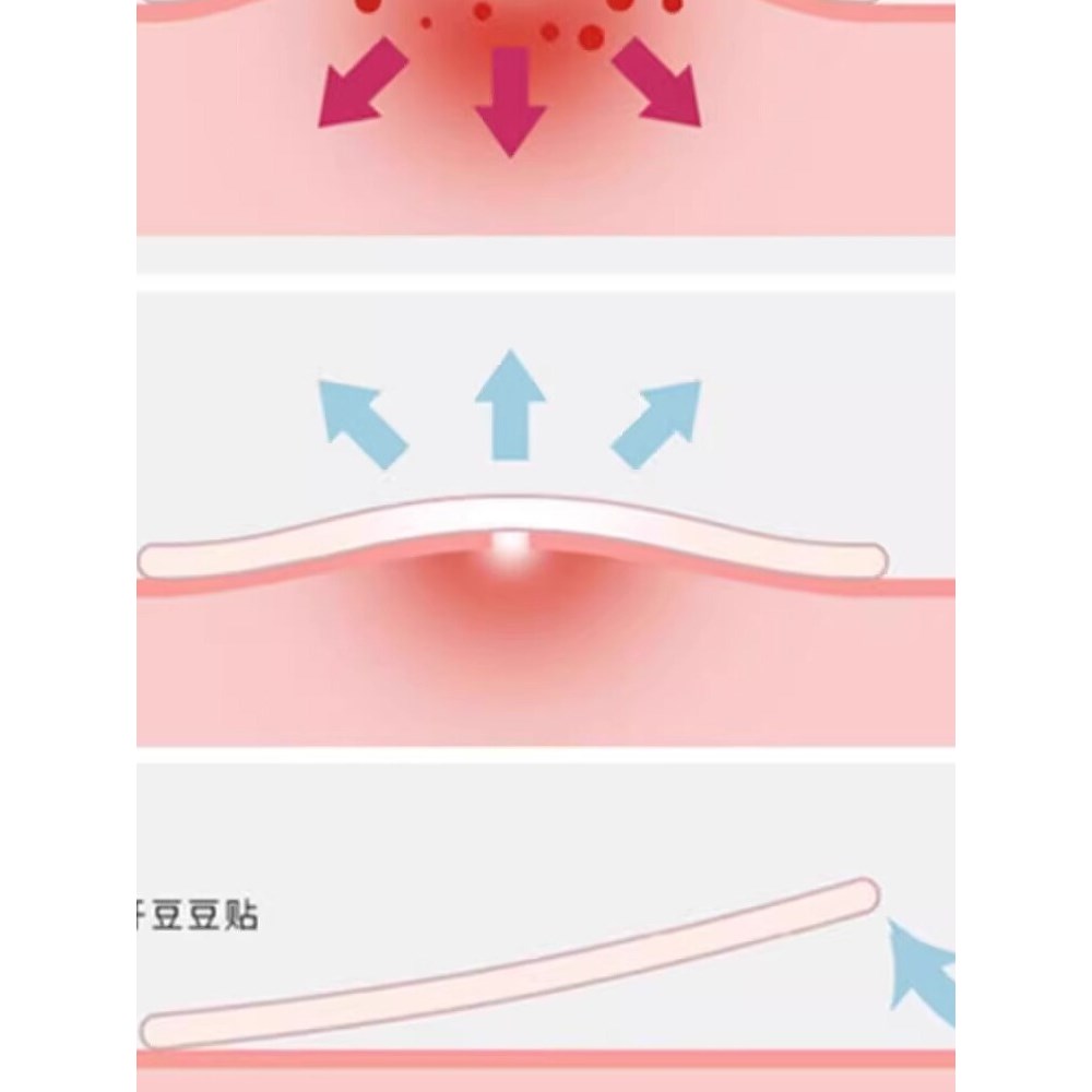 片仔癀痘痘贴祛痘贴消痘贴吸痘吸脓净痘贴青春痘淡化痘印6包/72贴-图3