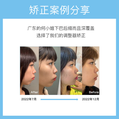 成人下巴后缩矫正器前突短下巴宽大过长厚调整下颌颚歪斜纠正神器 - 图1