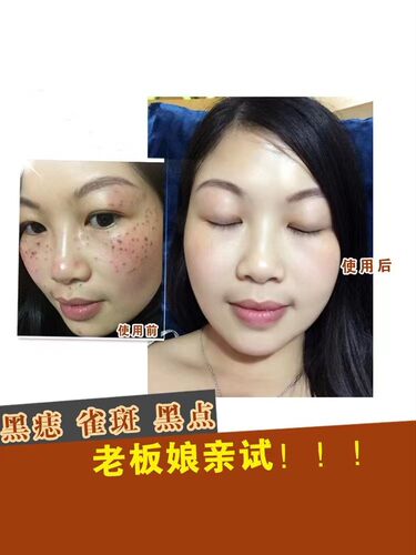 点斑水无痕正品水祛遗传雀斑老年斑痣黑点痦子药水美容金水美容院 - 图0