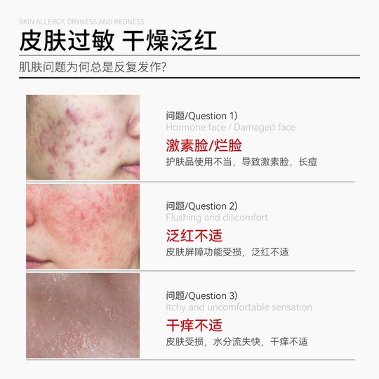 SKLEER姜黄修复凝胶天然皮肤调理激素烂脸脂溢性炎泛红敏感肌临期