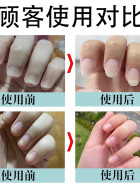 护甲油养指甲游离线增厚咬指甲受损萎缩修护养甲床修复液受损再生