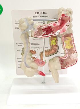 大肠病理DKH体模型大肠道模型大病变肠模型肠疾病人结肠病变模型