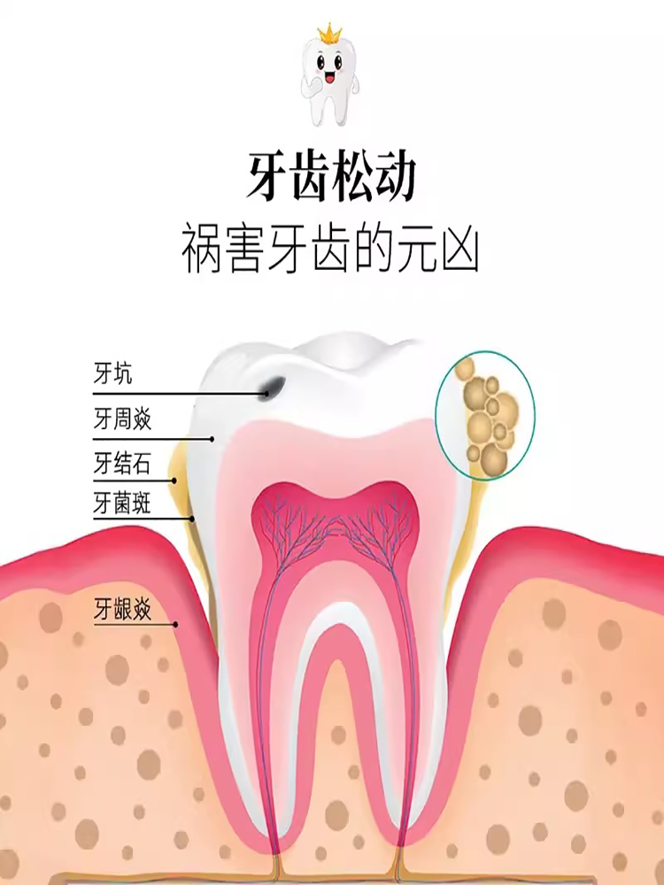 牙齿松动固齿喷雾牙膏牙龈肿痛萎缩牙痛牙齿晃动治牙齿松动的药AZ - 图1