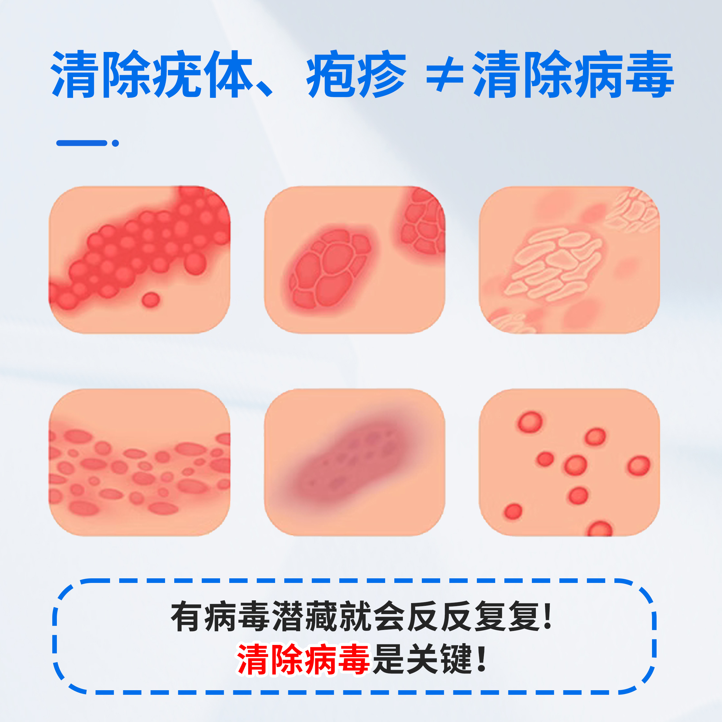 医用生物凝胶敷料生殖器疱疹药膏hsv2女男非干扰素单纯特星效性克