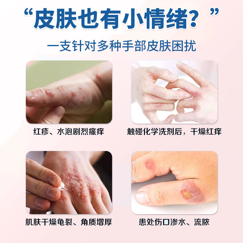 手部湿疹止痒去角化型湿疹克星根外用顽固皮炎真菌感染脱皮干裂EK-图0
