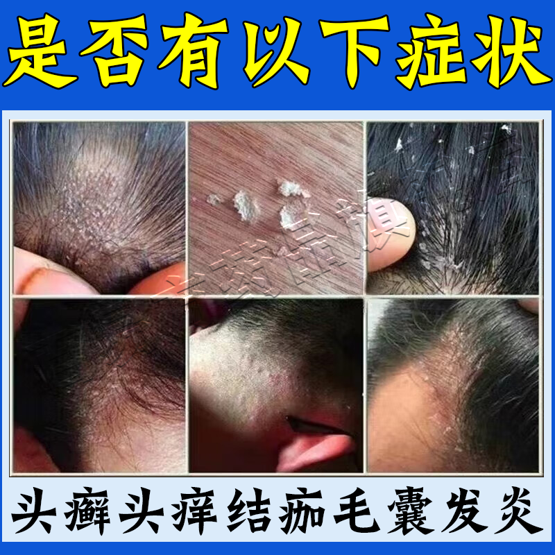 达克宁硝酸咪康唑软膏正品头皮屑脂溢性皮炎真菌感染头癣药膏,淘宝优惠券,粉丝福利购,淘宝优惠卷