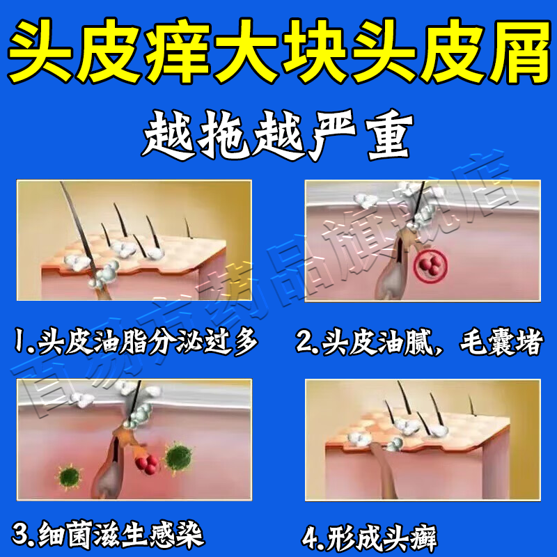 达克宁硝酸咪康唑软膏正品头皮屑脂溢性皮炎真菌感染头癣药膏,淘宝优惠券,粉丝福利购,淘宝优惠卷