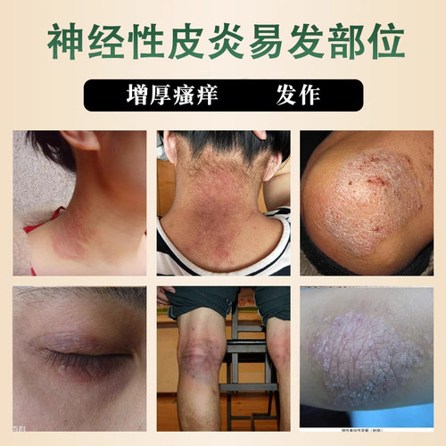 神经性皮炎特药效治疗顽固外用膏止痒肤病癣藓湿疹真菌感染瘙痒LT - 图0