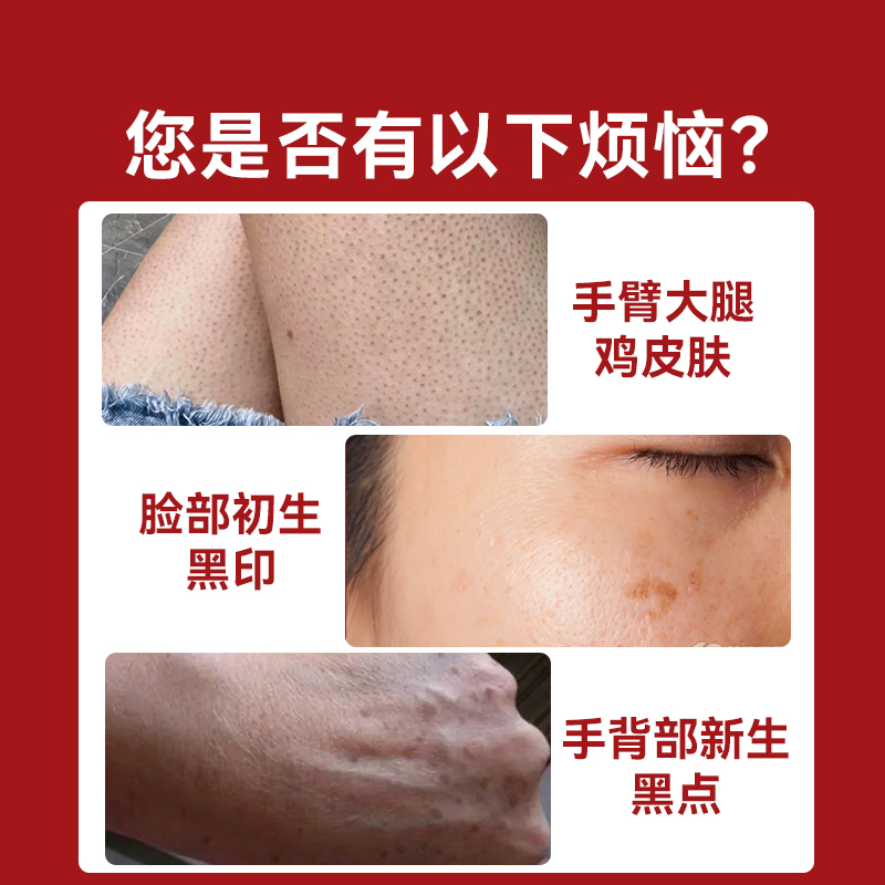 维a酸乳膏医用官方旗舰店维a酸乳胶膏a维酸乳膏尿素乳膏去鸡皮肤