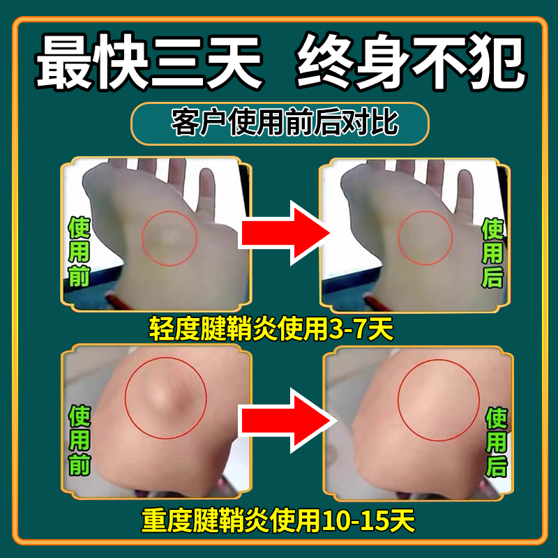 治疗腱鞘炎特效药手腕护腕关节疼痛晨僵手指固定消除囊肿鼓包贴膏 - 图2