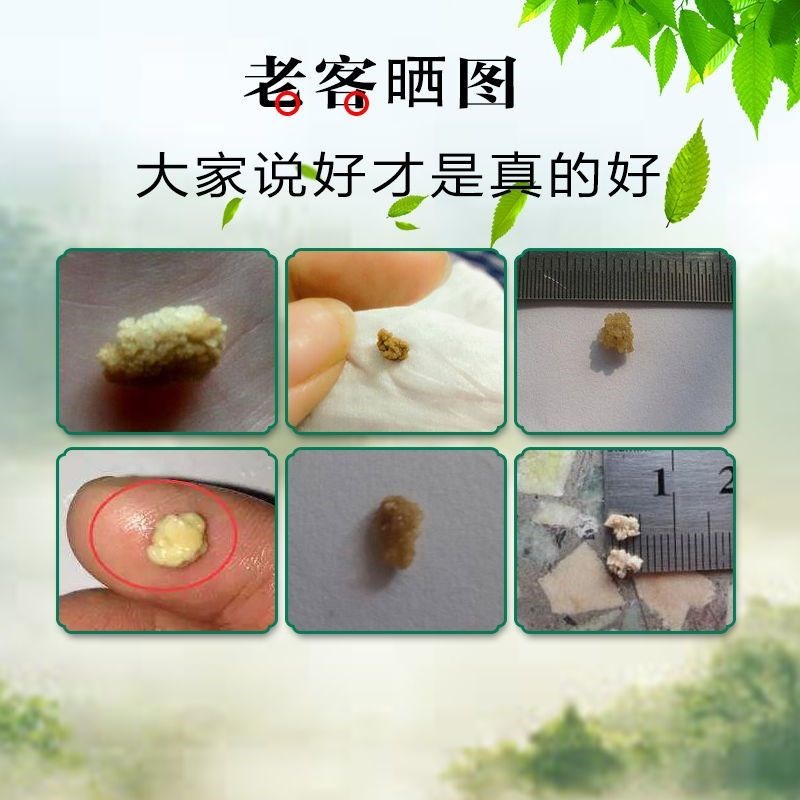 石克清片化石溶石碎石去胆囊输尿管肾石茶石同仁堂健康