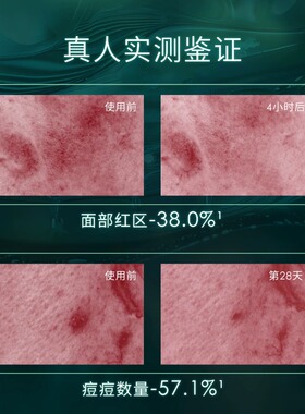 华西专利安碧妍屏障修护次抛