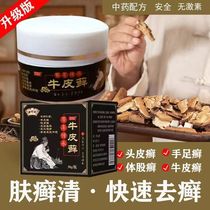Miao Agpsoriasis Old Stubborn Body Ringworm Head Ringworm Foot Moss Skin Itching Eczema Dermatitis Skin Itching Outside