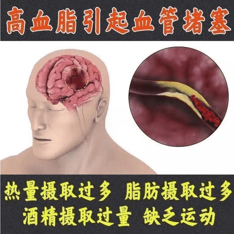 血管清道夫血脂高专用药降血脂疏通心脑血管堵塞脑梗通血管中成药