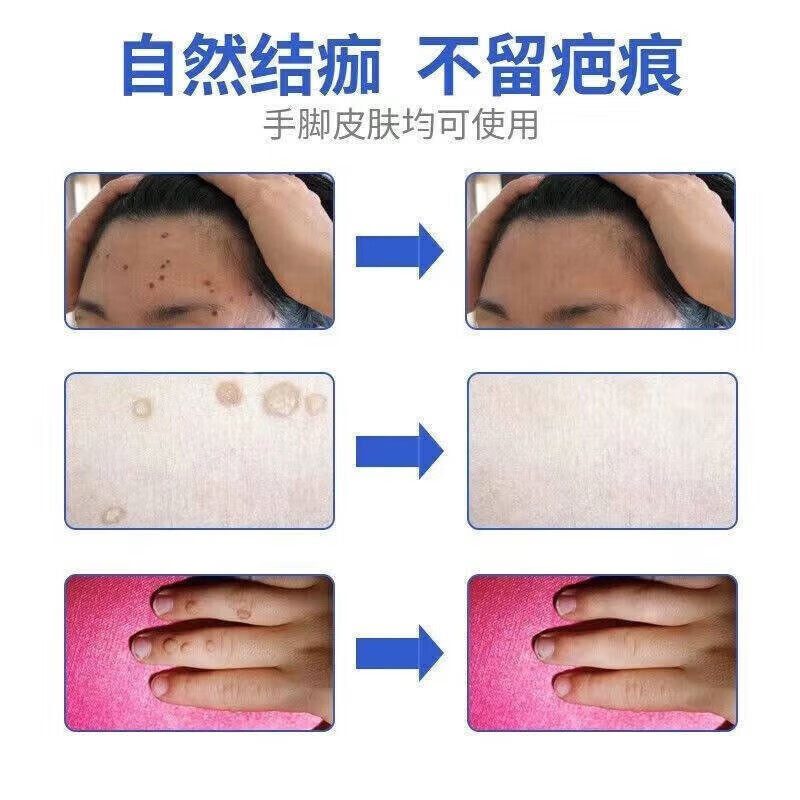 扁平疣祛除软膏去尤瘊脖子上长小肉粒丝状疣一抹灵专用维A酸乳膏