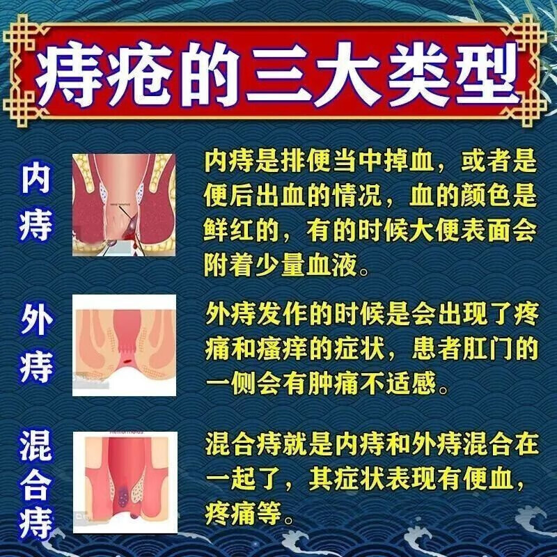 马应龙痔疮膏正品治痔疮特疼痔疮有肉球内痔外痔混合痔出血效药膏