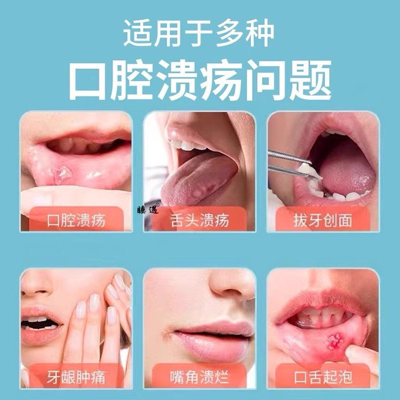 法兰度重组人干扰素a-2b医用口腔液体敷料口腔溃疡型牙周炎咽喉炎