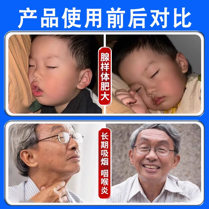 国药咽喉炎慢性咽炎贴咽扁非止咳化痰咽喉肿痛喉咙发炎官方正品xm