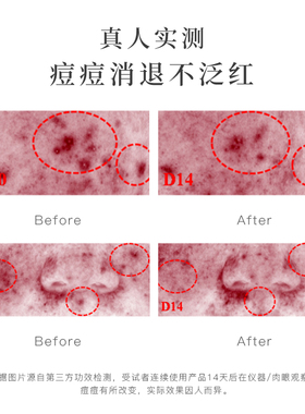 寻荟记茶树祛痘膏淡化舒缓痘痘肌闭口粉刺芦荟胶学生祛痘凝胶凝露